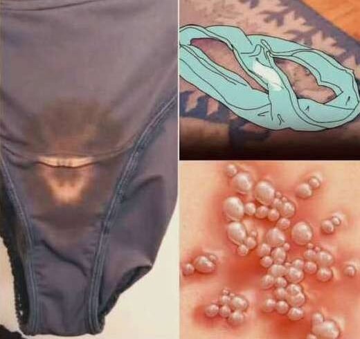Why You May Notice Bleach-Like Stains on Your Underwear: Causes, Concerns, and When to See a Doctor