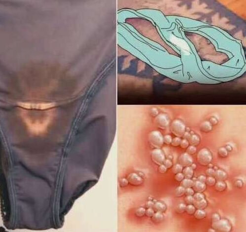 Why You May Notice Bleach-Like Stains on Your Underwear: Causes, Concerns, and When to See a Doctor