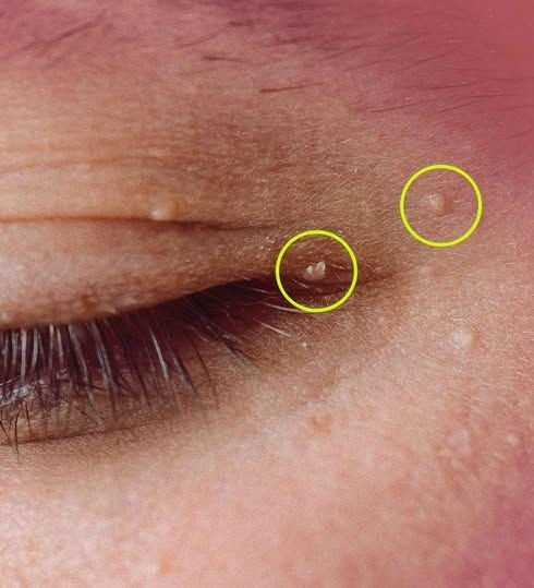 How to Get Rid of Milia: Those Annoying Fat Cysts