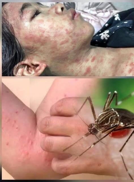 ALERT: New Disease Outbreak in China — Over 7,000 Cases Reported, Symptoms and Risks Revealed…see more
