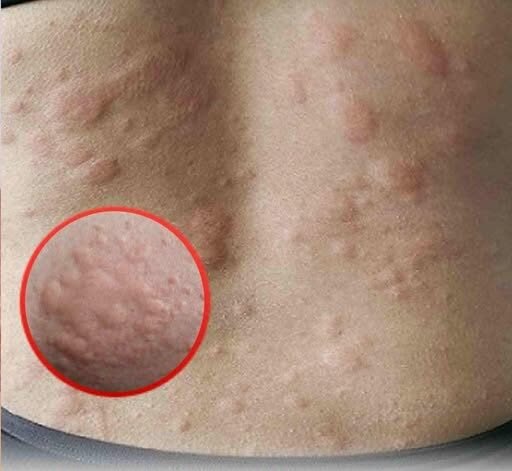 18 Signs of Histamine Intolerance (and what causes it)