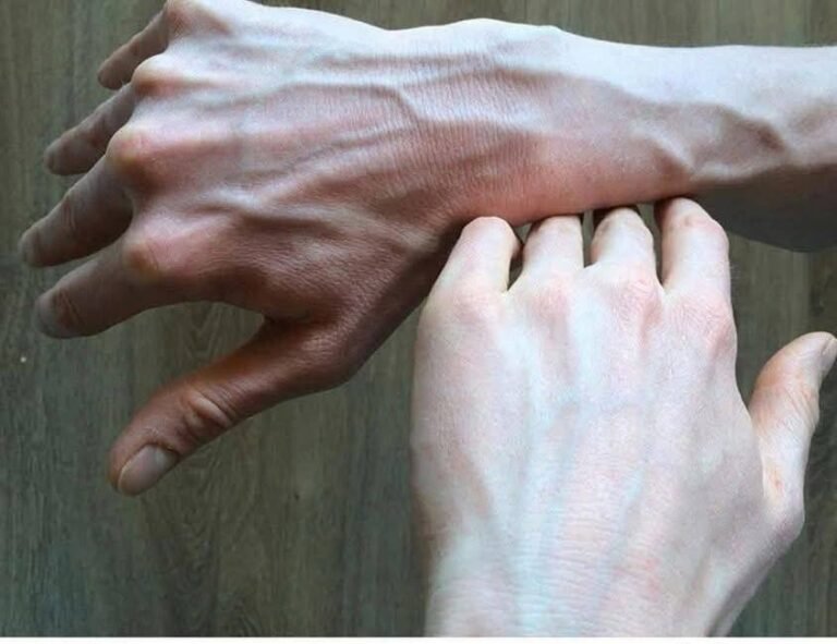 Why Are My Veins Suddenly Bulging and Visible?