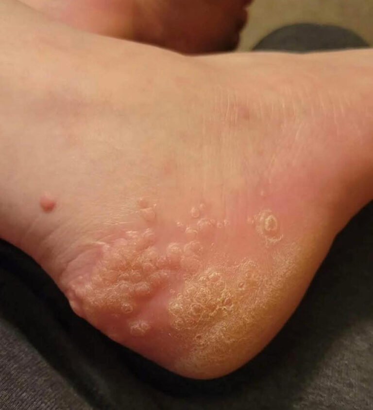 These Are the Consequences of Wearing Used Shoes A Small Mistake That Can Leave a Painful Mark