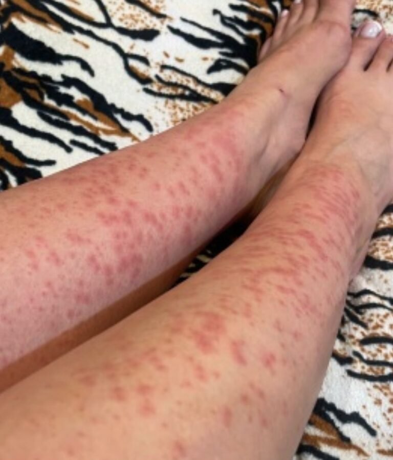 The Unseen Guest: Navigating a Persistent Bed Bug Infestation