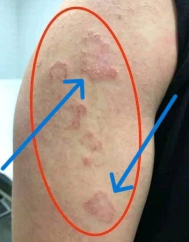 Is That Red Circular Rash On Your Arm Actually Highly Contagious