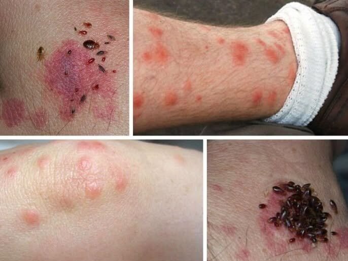 BE CAREFUL if you get these bruises on your body, it means you have Ca…