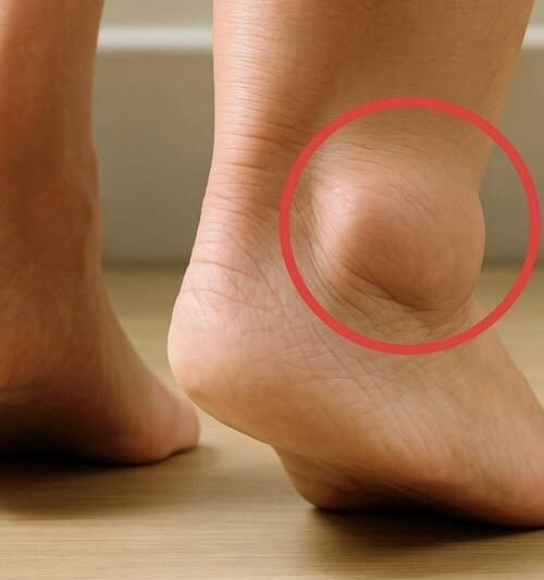 What Causes Swollen Feet in Seniors?