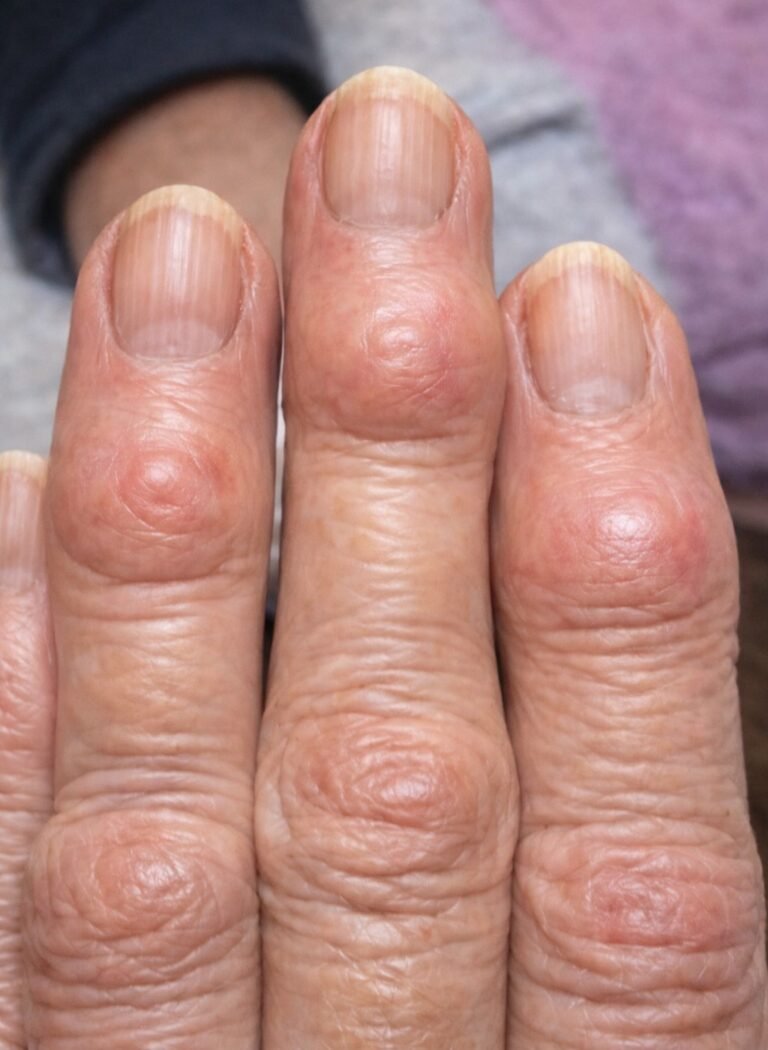 My grandma has these hard bumps forming on her finger joints near the nails. Why is this spreading?
