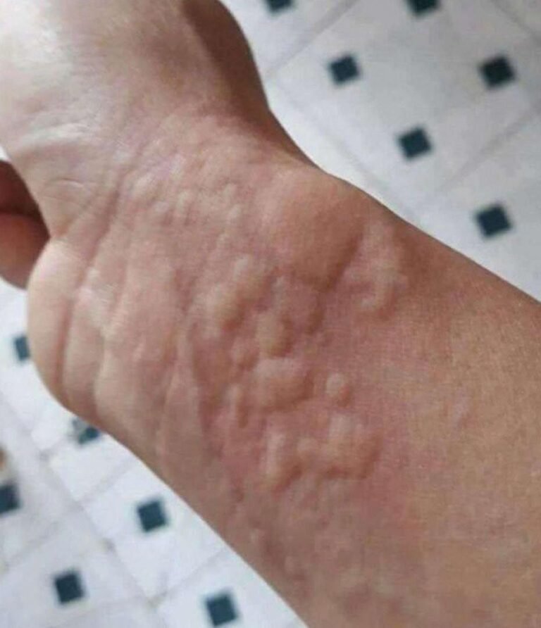 The Silent Killer on Your Skin, Why Hives and Breathing Changes Are a Deadly Signal You Cannot Afford to Ignore