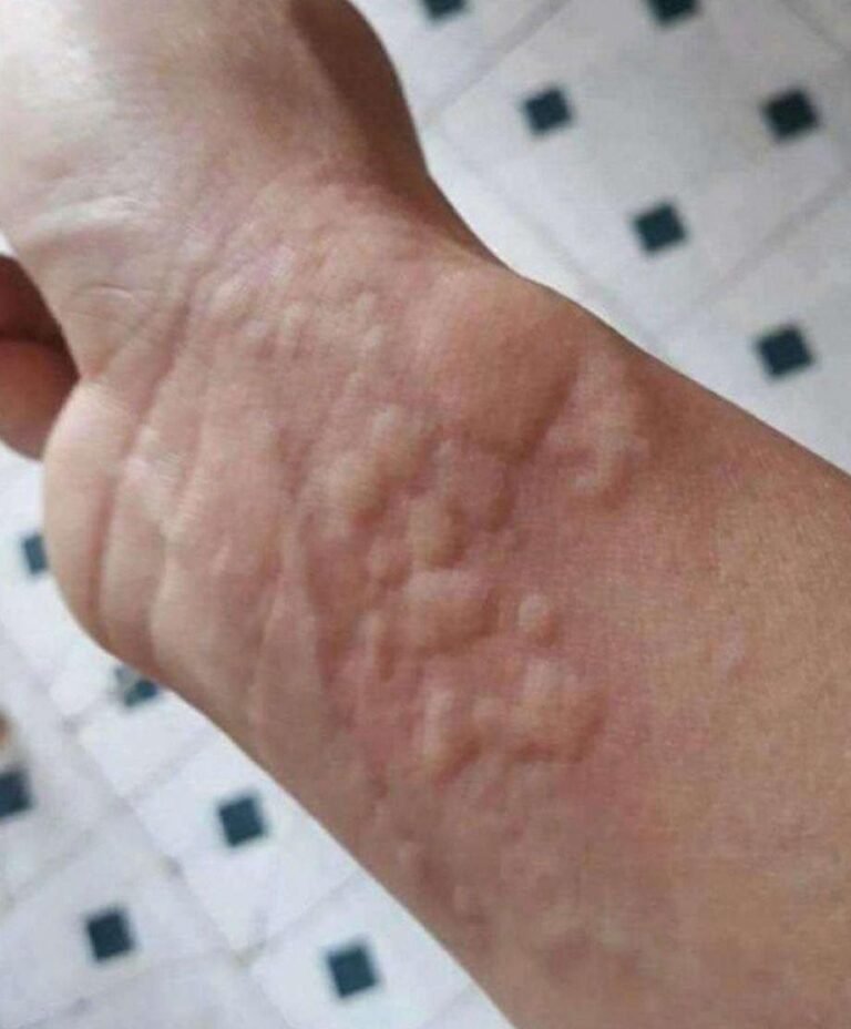 Ignoring Sudden Skin Reactions Can Lead To Very Serious Health Emergencies