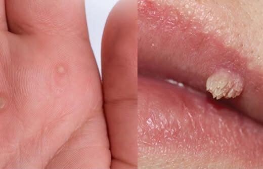 Safe Home Remedies for Warts: What Works, What Doesn’t, and What to Expect