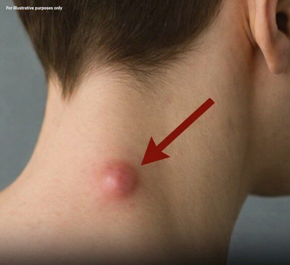 Understanding Epidermoid Cysts: Causes, Symptoms, and Treatment Options