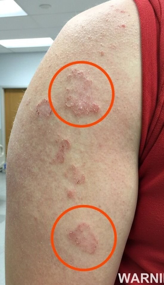 Understanding Red, Ring-Shaped Rashes: Causes and Treatment Options