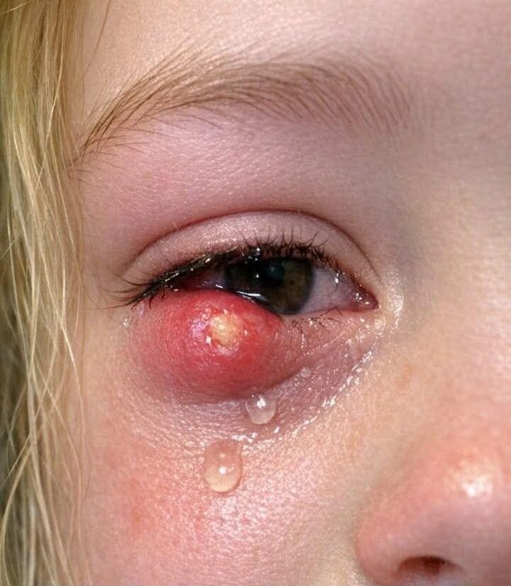 😱 My Daughter Just Woke Up Screaming With This Giant Lump on Her Eyelid