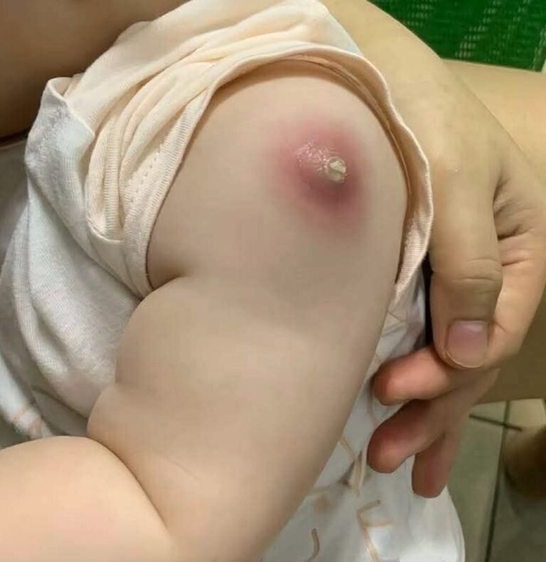 ⚠️ Warning: Red Swelling After a Vaccine? What Parents Should Know Before Panicking… See More 👇