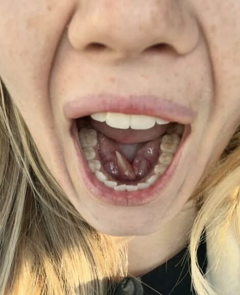 What is growing in my girlfriends mouth?