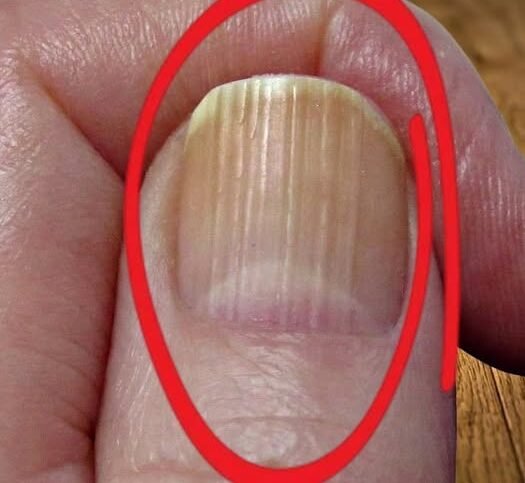 What Vertical Lines on Your Nails Can Reveal About Aging