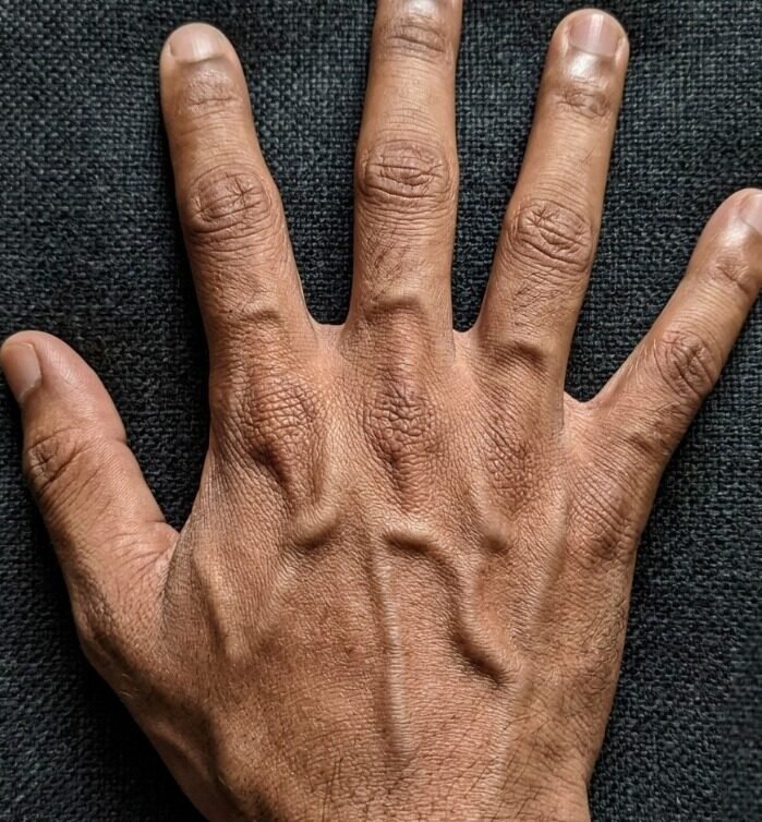 Why Prominent Hand Veins Are Often Harmless Physical Traits