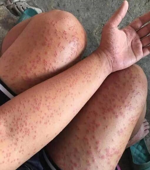 The Hidden Killer In Your Bed Why Waking Up With These Itchy Red Patches Is A High Stakes Medical Emergency That Could Shut Down Your Ability To Breathe In Minutes