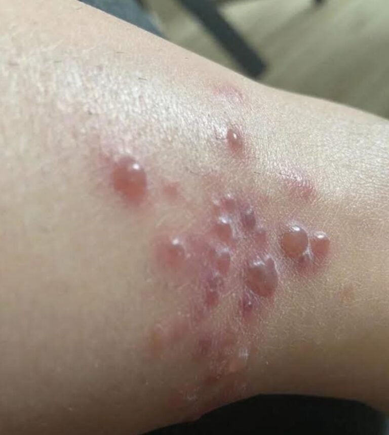 I went to this trail with my friends to go walking when we went walking on the trail I got bit by some insects on my leg now these blisters appeared and they hurt …See more