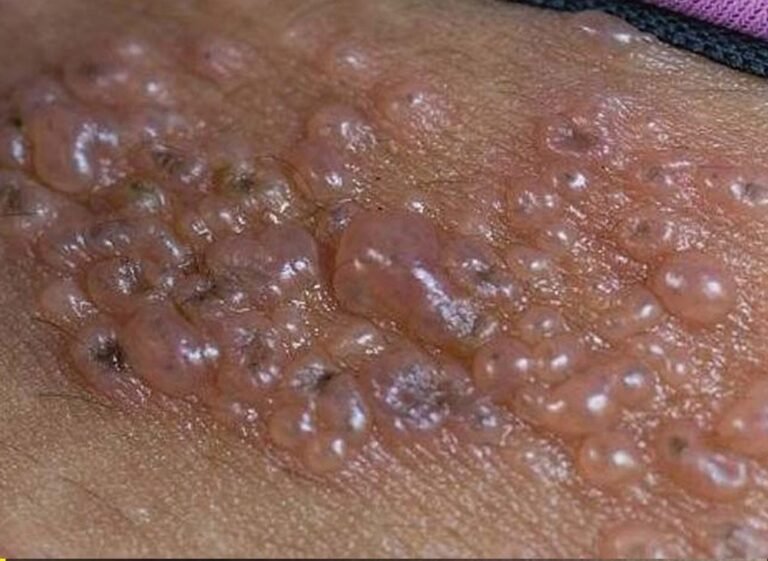 This Is the Silent Disease That Is Triggered When You Come Into Contact With Contaminated Surfaces… Most People Ignore the First Signs 😳